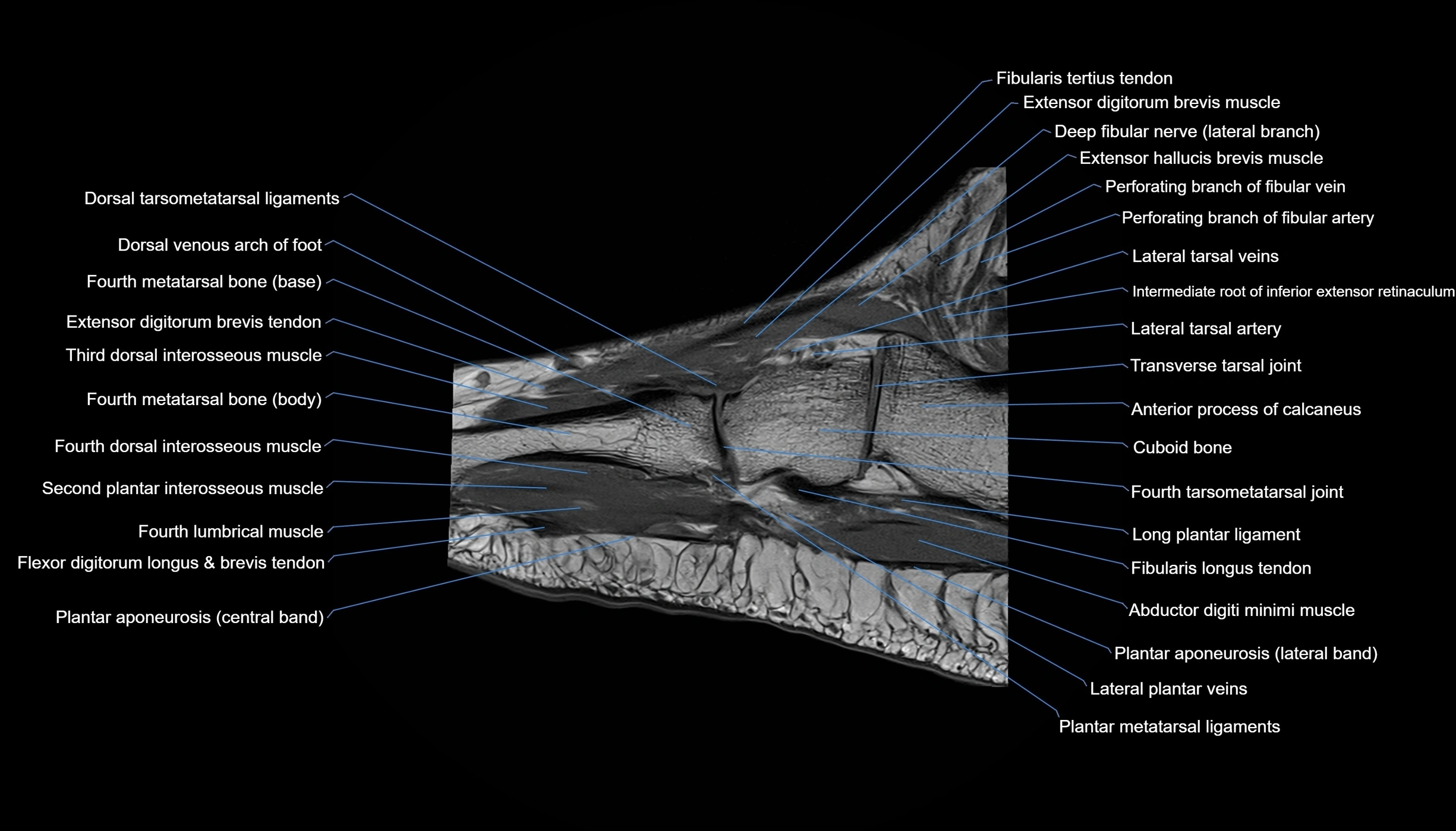 MRI mid foot sagittal cross sectional anatomy 3T  radiology  image-img-00001-00013.webp